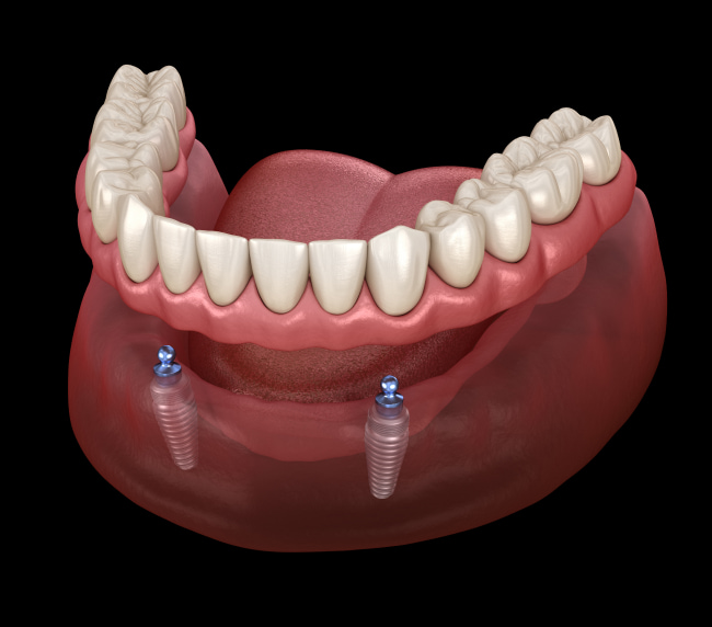 Snap-In Dentures