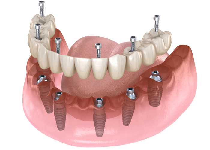 Fixed vs. Removable Solutions