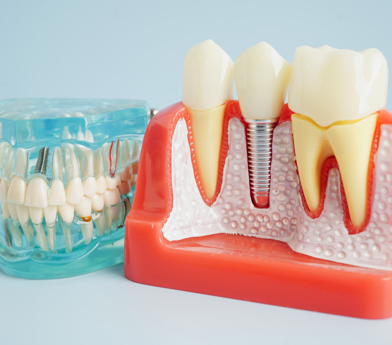 Exploring Tooth Replacement Options
