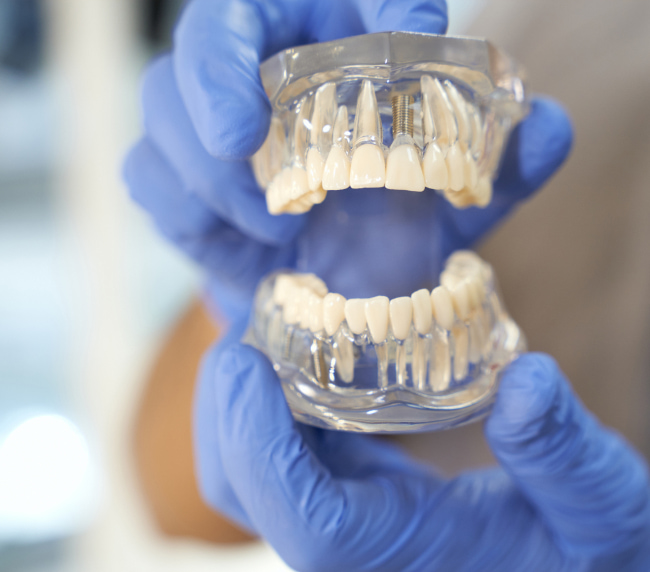 Teeth-In-A-Day Solutions